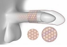 Aumento do pene en volume