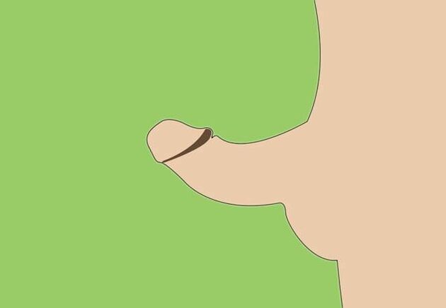 Curvatura do pene como indicación para a ampliación cirúrxica